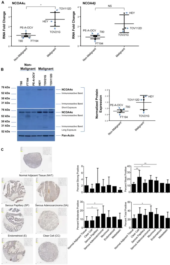 Figure 6: Increased NCOA4 expression in malignant gynecological cells and human OVCA tissues