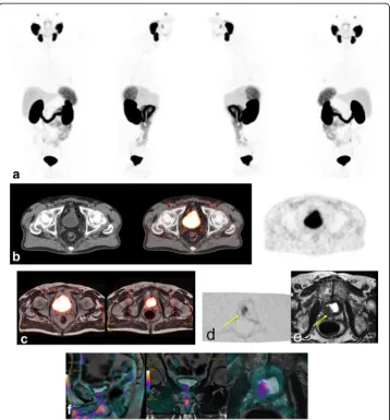 Fig. 5 Patient 36. MIP 68Ga-PSMA images (a) of a 68-year-old patient with PCa treated with surgery with currentelements of biochemical relapse (PSA level 0.2 ng/ml).68Ga-PSMA PET/CT (b) and 68Ga-PSMA PET/MR images (c)without abnormal pelvic findings