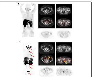 Fig. 2 Patient 5. A 68-year-old patient with PCa treated with radiotherapy and complete androgen blockadewith current elements of biochemical relapse (PSA level 2.33 ng/ml), scanned with 11C-Choline (a) and with68Ga-PSMA (b).Several metastases are demonstr