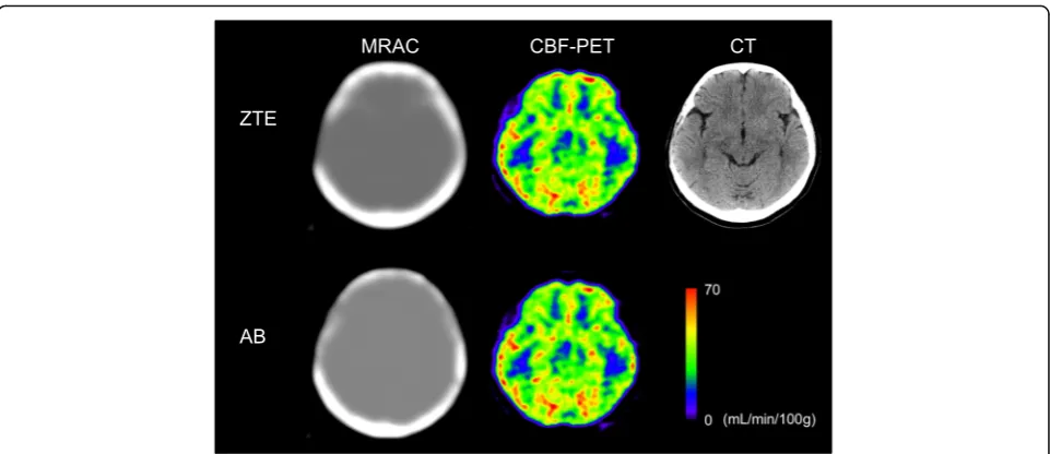 Fig. 7 ZTA-, AB-MRAC, and CBF images at the same slice level from a patient who underwent neurosurgical treatment