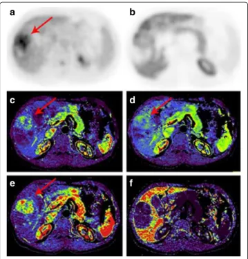 Fig. 4 PET/CT and CT-perfusion in low-differentiated hepatocellular carcinoma. Patient B