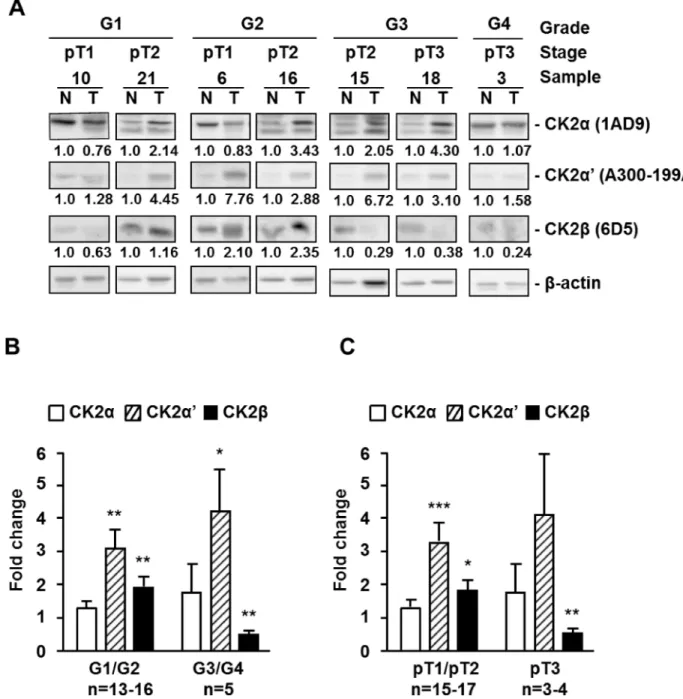 Figure 1: Protein kinase CK2 subunits expression in different extracts of human ccRCC biopsies