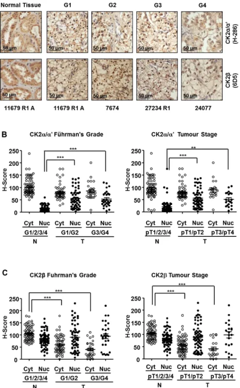 Figure 2: Expression of CK2 subunits in the 98 ccRCC samples embedded in Tissue Microarrays (TMAs)