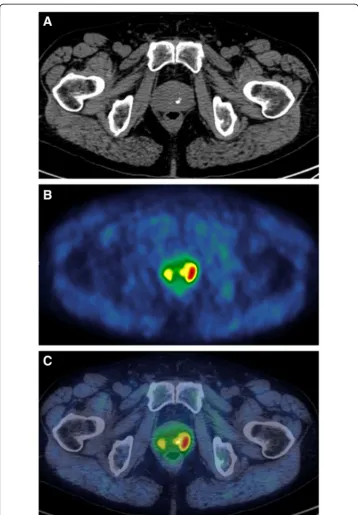 Fig. 1 Focal uptake detected on the periphery of the left prostatic lobe. a CT scan; b 11C-choline PET scan;c 11C–choline PET/CT fused scan