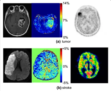 Fig. 4 APT (left) and PET (right) images of a tumor and b ischemic stroke (MR and PET images are in eachcase from different patients)