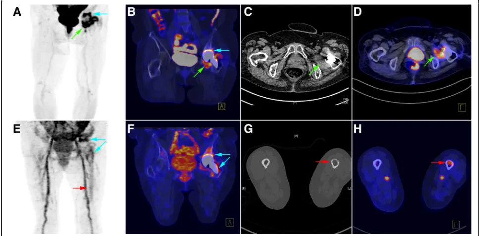 Fig. 3 Patient (case # 14) with a history of hip prosthesis implantation performed 8 months before imaging