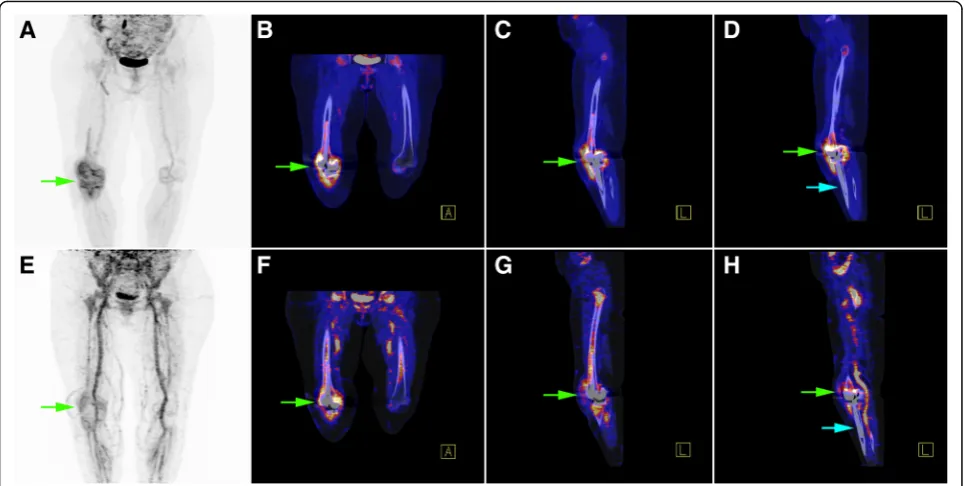 Table 3 Diagnostic performances of 68Ga-citrate PET/CT and18F-FDG PET/CT imaging in detecting infected prosthesesaccording to the anatomical site
