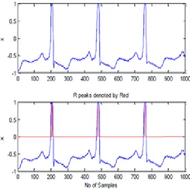 Fig. 13 shows R peak detection using continuous wavelet transform. 