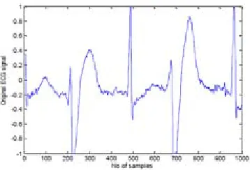 Fig 5. Shows an ECG signal (200_1 MIT-BIH database) containing 1000 samples. Fig.6 shows the various IMF’s of 