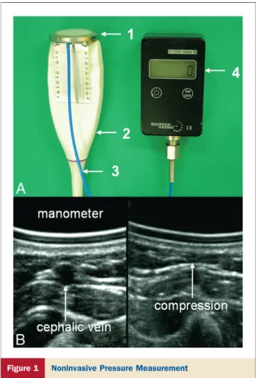 Figure 1 Noninvasive Pressure Measurement