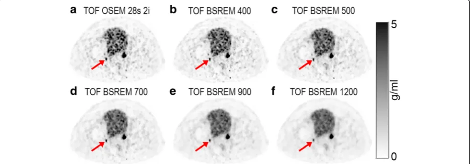 Figure 6and CR decrease for most lesions. Although all lesionsthe percentage change in CR compared to the referenceTOF OSEM with 28 subsets and 2 iterations, which isalso shown in Fig