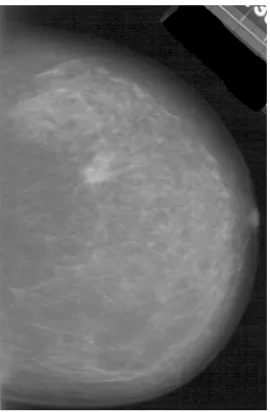 Figure 1 shows a mammogram image with many fine details. Figure 2 shows the image in Figure 1 after 20x20 averaging filter has been applied to reduce the detail