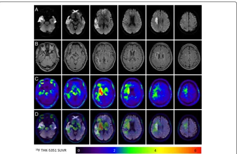 Fig. 1 18F-THK-5351 retention patterns in an ischemic stroke patient (case 6). a The acute ischemic location on diffusion-weighted imaging (DWI).b, c The FLAIR images and 18F-THK-5351 PET images taken 3 months after stroke, respectively