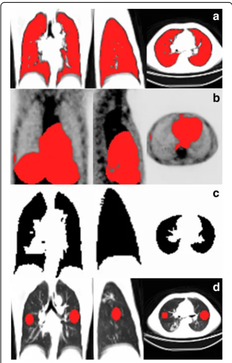 Fig. 2 Example of volumes of interest (in red) required for quantification.misregistration (usually the mediastinum, liver and spleen) drawn on theoverlaid PET images