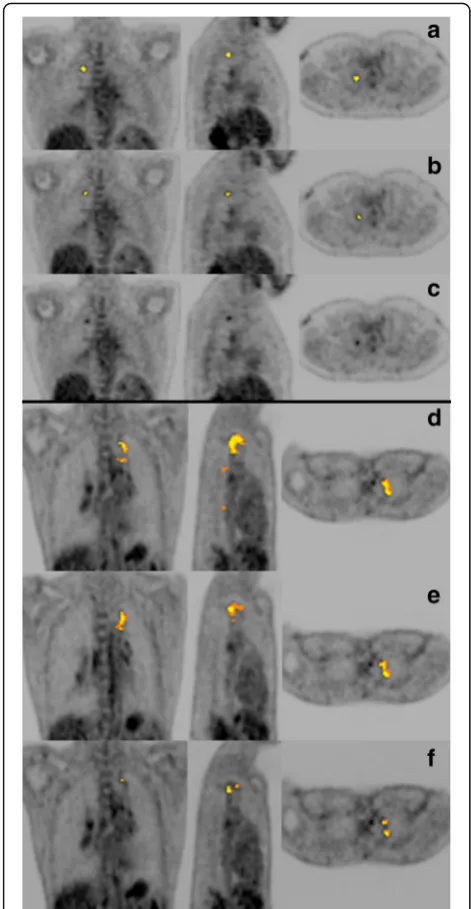 Fig. 4 Coronal (left), sagittal (middle) and transverse views of PETscans of two patients after treatment for pulmonary tuberculosis.The first patient (a–c) has a residual nodule in the right upper lobeshowing minimally increased FDG avidity