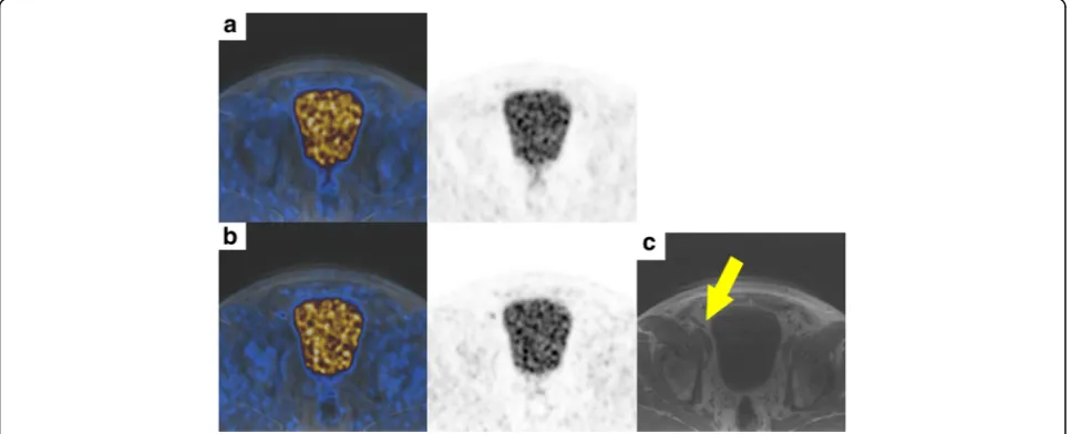 Fig. 4 Images of a patient with a PET-positive lesion along the right external iliac vessel diagnosed as a lymph node metastasis of prostate cancer.a Fusion image (left) and PET image (right) of simultaneous 18F-choline non-TOF PET/MR