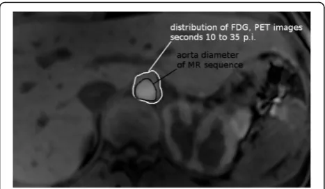 Fig. 4 Fused image of MRI T1 sequence and PET. From the latter, thesum of the second to seventh frame (i.e., seconds 10 to 35) p.i