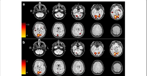 Fig. 1 Representative transverse SISCOM images of a 53-year-old patient with clinically temporal lobe epilepsy caused by an epidermoid tumor inthe left occipital lobe, at the base of the skull at z-score thresholds of 1.5 and 2, superimposed on the preoper