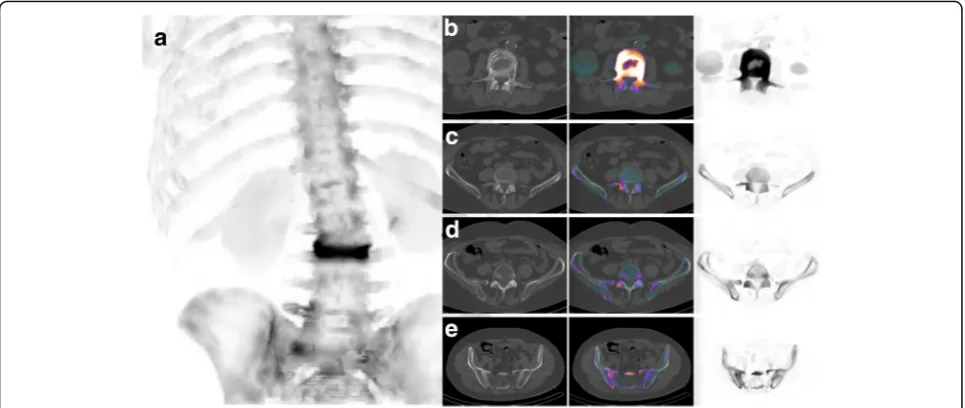 Fig. 1 Example of an xSPECT Bone reconstruction providing SPECT images with bone anatomy appearance