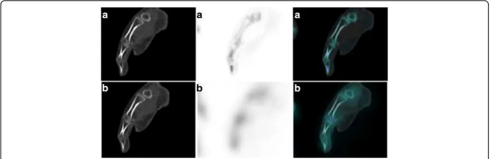 Fig. 2 Example of false positive of xSPECT Bone®. This SPECT/CT was performed in order to explore a focal distal thumb pain persisting after atraumatism occurred several months ago