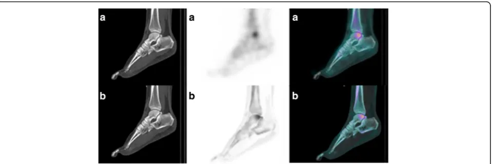 Fig. 5 Example of a better location of a pathological uptake with xSPECT Bone® reconstruction