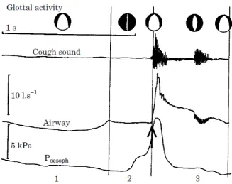 Figure 2.1: Adapted image and caption from Korpas et al. ‘Representation of glottalactivity, time, records of cough sound (recorded by multiscriptor), airﬂow and oe-sophageal pressure (inspiration downwards) during one cough eﬀort (indicated withthe ↑) in 