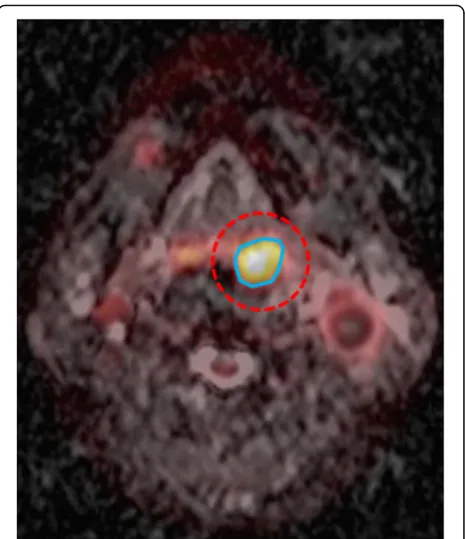 Fig. 1 Measuring methods of simultaneous 18F-FDG PET/MRI parameters.As an initial step, the regional PET and ADC map were integrated