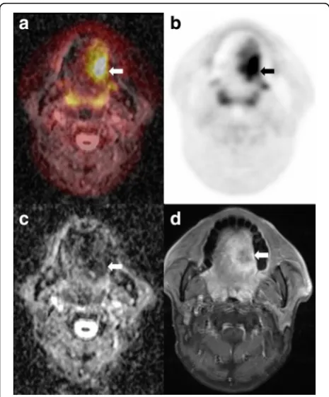 Table 5 Multivariate analysis with significant clinicopathologic and 18F-PET/MRI parameters