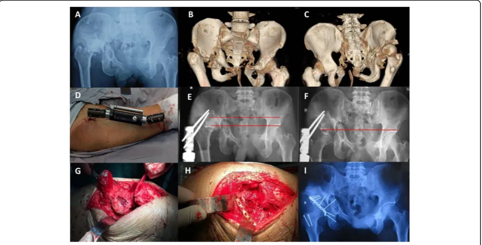 Fig. 1 Patient 12. a-c Preoperative X-ray and three-dimensional reconstruction computed tomography images 6 months after injury