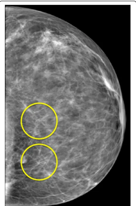 Fig. 1 A standard mammogram. Are the intersections in the twocircles actual structures or the accidental superposition of filamentsat different depths in the 3D volume of the breast?
