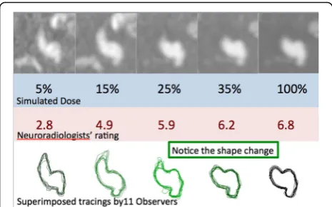 Fig. 3 Effects of simulated dose reduction on the ability to trace theshape of an aneurysm in a head CT image