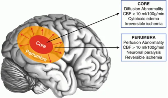 Figure 1.1: Representation of ischemic stroke [10]