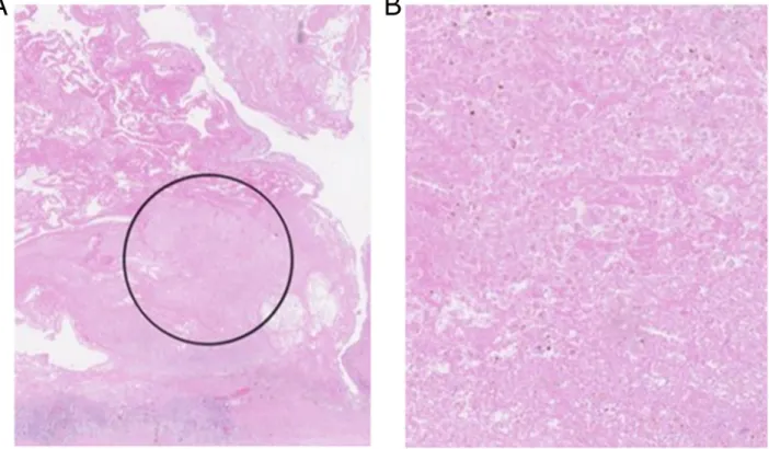 Figure 3: (A) H&amp;E stained FFPE Undifferentiated pleomorphic sarcoma tissue from participant 3
