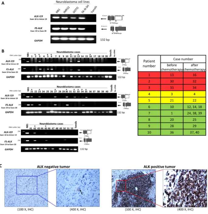 Figure 4: The expression of ALK-I19 and FS-ALK in formalin-fixed/paraffin-embedded (FFPE) NB tumors