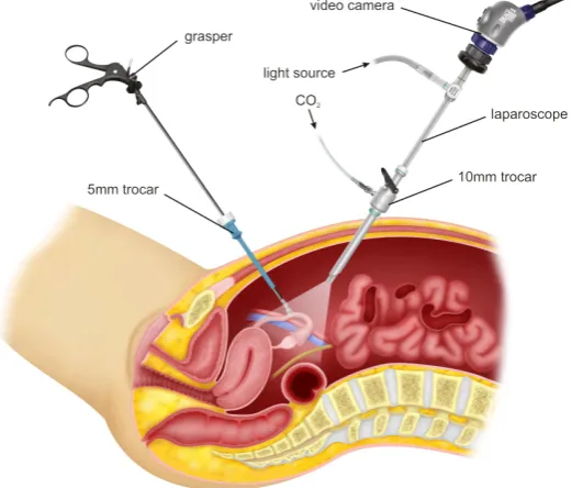 Figure 2.1: An example of Minimally Invasive Surgery with the use of an endoscope (Laparoscope, 2019)