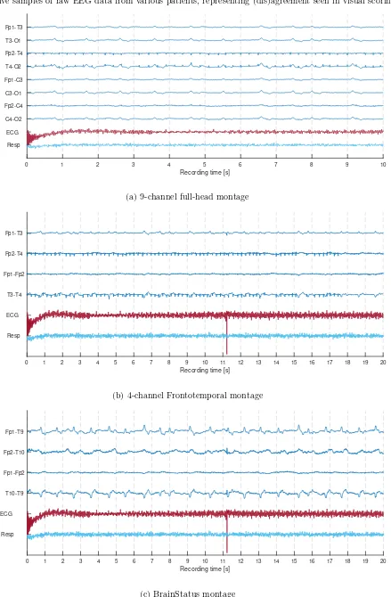 Figure 5: Selection of EEG from patient AMC224 at 24 hours after cardiac arrest: all montages scored as suppressed