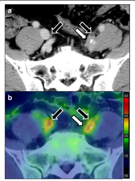 Fig. 1 CECT (a) and FDG-PET/CT (b) images demonstrating leftinternal iliac artery involvement (white arrow)