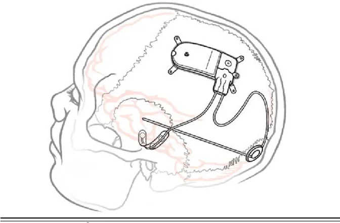 Figure 1:  The Implanted RNS ®  System. 