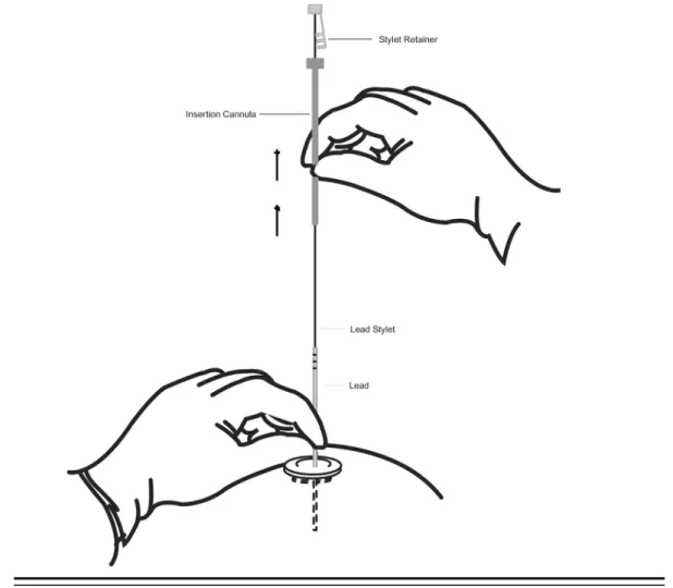 Figure 9: Removal of the insertion cannula, stylet, and stylet retainer from the lead