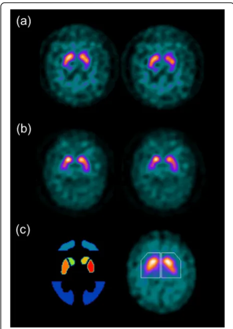 Fig. 6 Divergent quantitative diagnosis based on method offemale patient with a 3-year follow-up diagnosis of a dopaminergicdegenerative disorder (multiple system atrophy) which was normalusing BRASS quantification with the exception of striatal andputamin