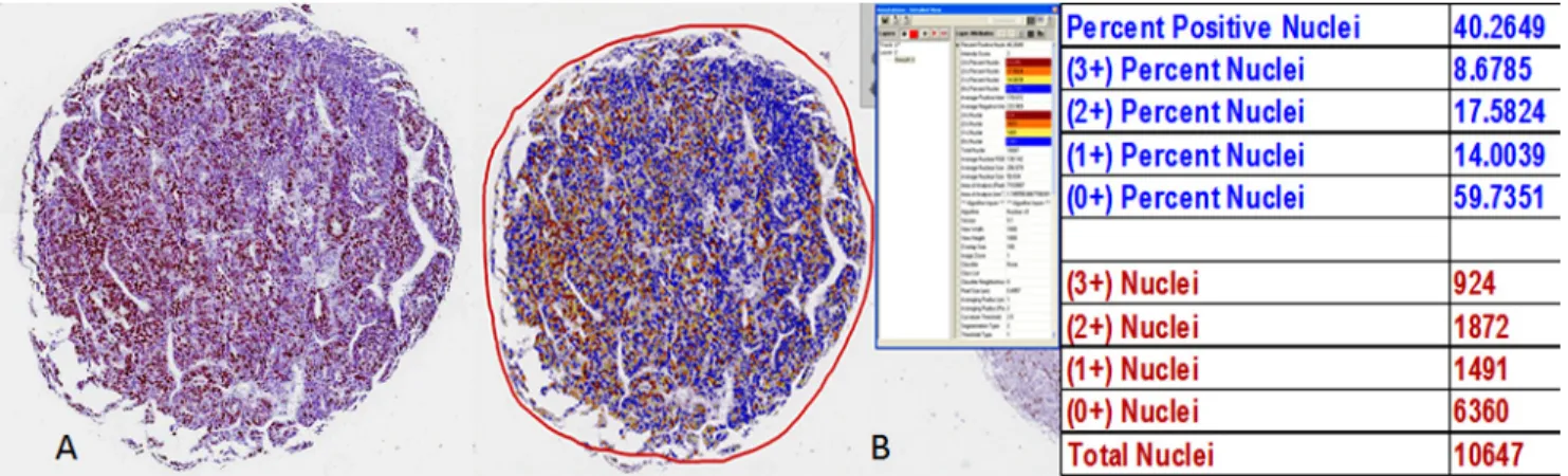 Figure 6: Determination of Ki67 analysis by the Aperio ePathology Immunohistochemistry Nuclear Image Analysis  algorithm.