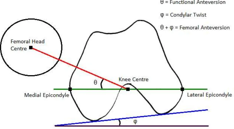 Figure 1b: Condylar twist angle - caused by medial femoral condyle being greater than that of the For Peer Review Onlylateral condyle which externally rotates the transepicondylar axis of the femur Yoshioka & Cooke (1987)