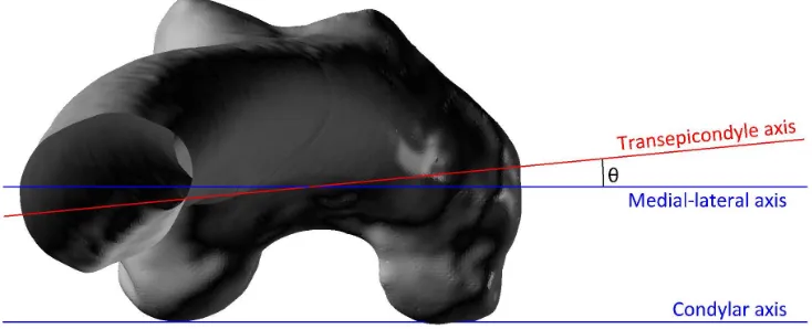 Figure 3: The angle between medial-lateral and transepicondylar axes when viewed in the For Peer Review Onlytransverse plane