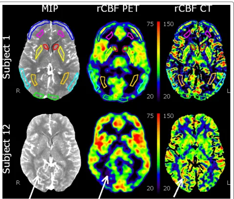 Figure 1 Co-registered transaxial slices through the level of the basal ganglia. Co-registered transaxial slices showing MIP from perfusionCT integrated over 40 s (left), the rCBF images using PET (centre), and perfusion CT (right) quantified in millilitre