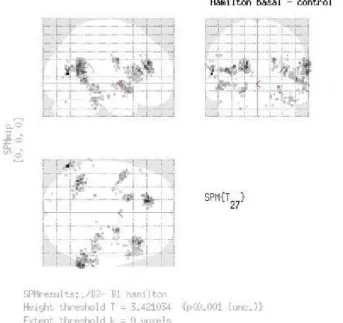 Fig. 2. In the whole group, SPM8 analysis demonstrated  association between decreased  perfusion and HAM-D scores considered as a covariate, at baseline and after 2 months of  therapy (non corrected p <0.001): -at left: in amygdala, anterior cingulate, 