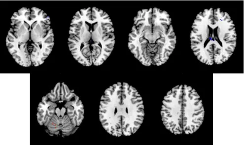 Fig. 3. Absence of regional cerebral blood flow change after SSRI therapy in T3 group, using  Statistical Parametric Analysis (SPM8) with significant level <0.001; uncorrected p value