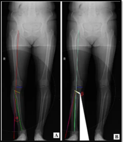 Figure	4:	Pre-operative	planning	on	a	WLR	in	2D.	On	image	A	the	red	line	represents	the	desired	mechanical	axis.	 The	yellow	line	marks	the	cutting	plane	of	the	wedge.	The	green	line	runs	from	the	hinge	point	of	the	osteotomy	cut	 to	the	middle	of	the	talu