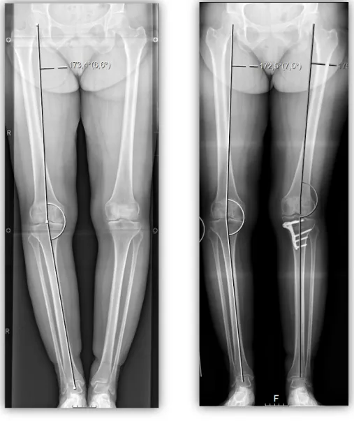 Figure	5:	Whole	leg	radiographs	taken	from	the	same	patient	on	different	time	points.	The	left	image,	before	an	 osteotomy	in	the	left	leg,	shows	a	measured	HKAA	of	6.6°	in	the	right	leg.	The	right	image,	after	an	osteotomy	in	the	 left	leg,	shows	a	measur
