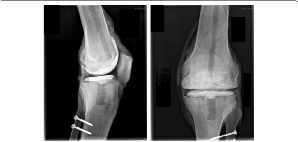 Fig. 3 One knee specimen implanted with hand-moulded spacers