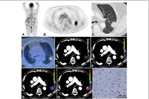 Figure 1 Patient with peripheral adenocarcinoma of the left lower lobe. (A) Coronal PET-MIP, (B) axial PET, (C) axial CT in lung window, and(D) axial 18F-FDG-PET/CT co-registration